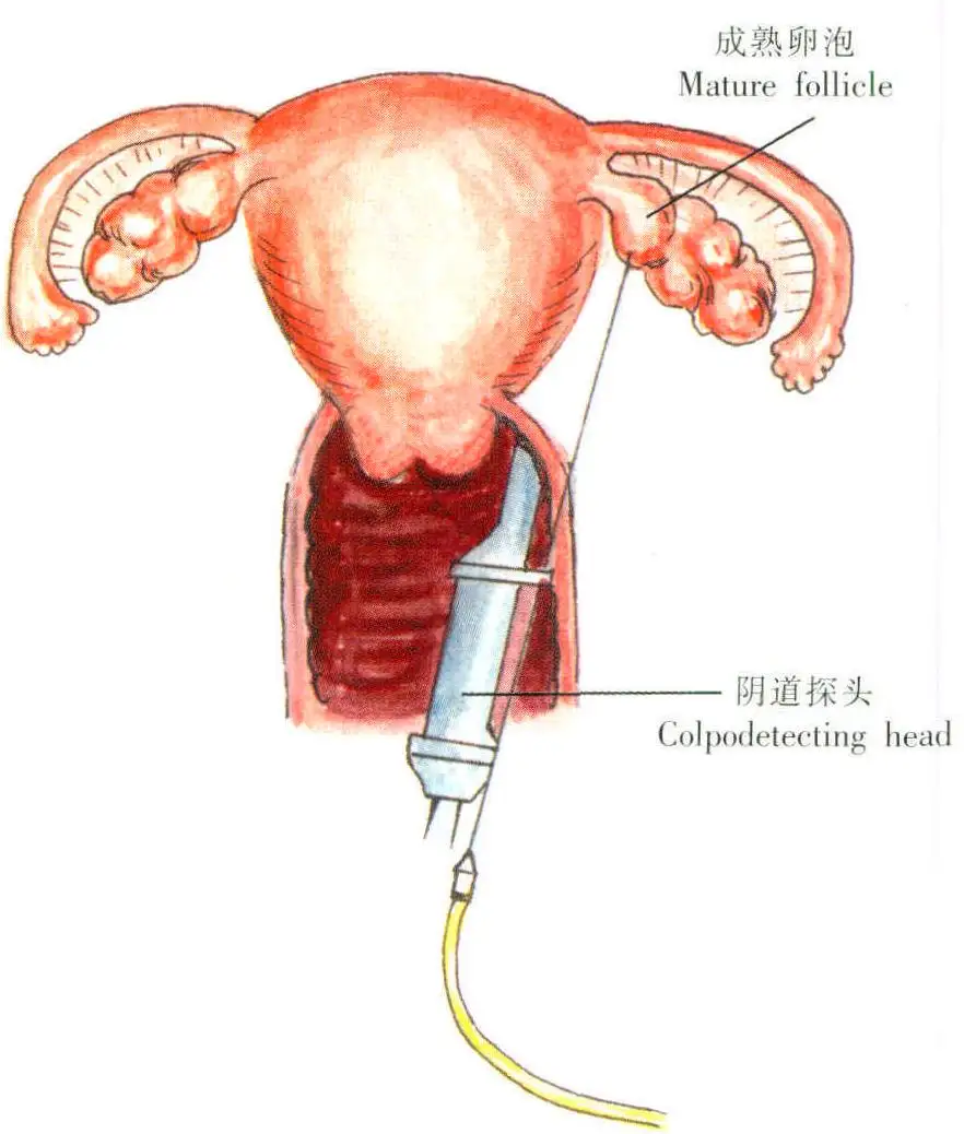 武汉女性取卵会对卵巢造成伤害吗？