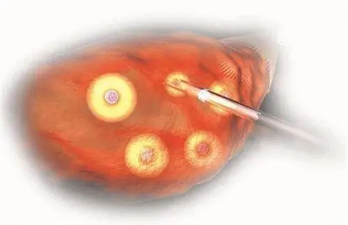 武汉取卵手术是如何进行的？