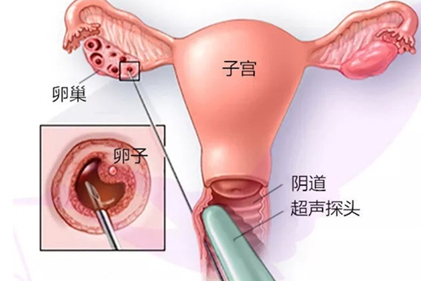 取卵的过程痛不痛？